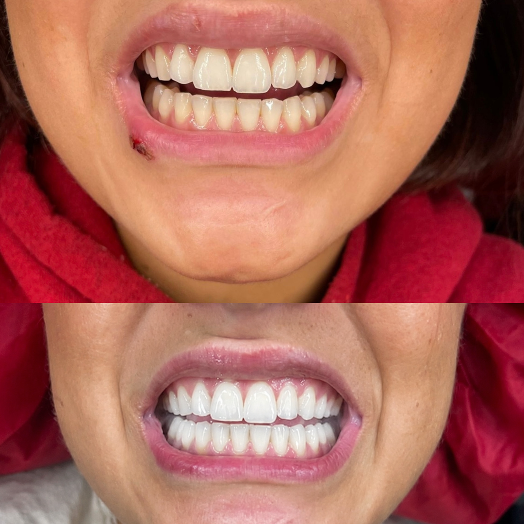 BUNDELKORTING - PAP + whitening strips Non Toxic