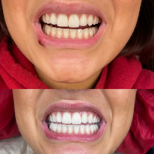 BUNDELKORTING - PAP + whitening strips Non Toxic